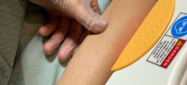 Hair Removal Treatment