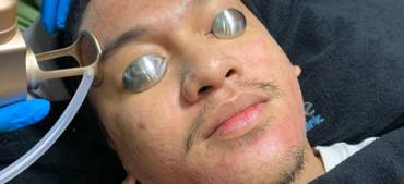 Pengobatan Pori-pori dan Scar